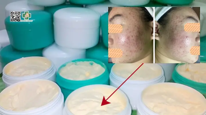Đối Với Mụn Trung Bình, Mụn Nặng Và Các Trường Hợp Khác