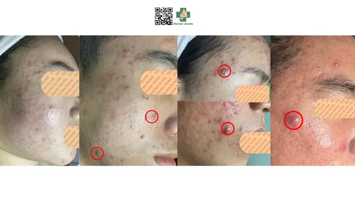 Mụn Trung Bình Và Nặng