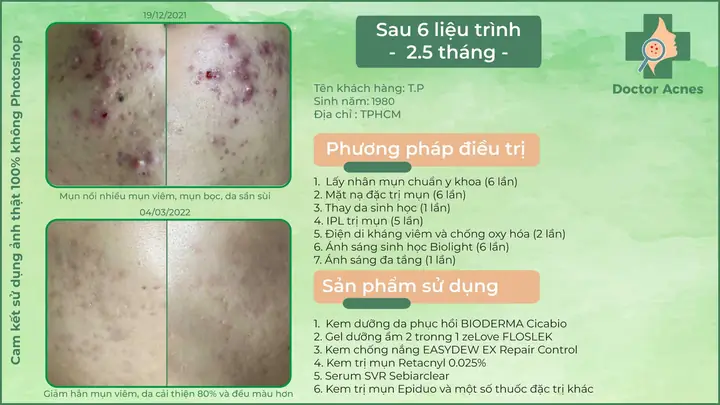 Đối Với Mụn Trung Bình, Mụn Nặng Và Các Trường Hợp Khác