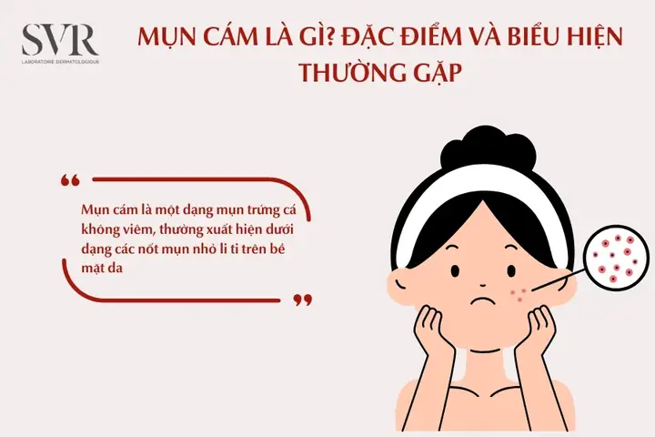 Mụn Cám Là Gì? Đặc Điểm Và Biểu Hiện Thường Gặp