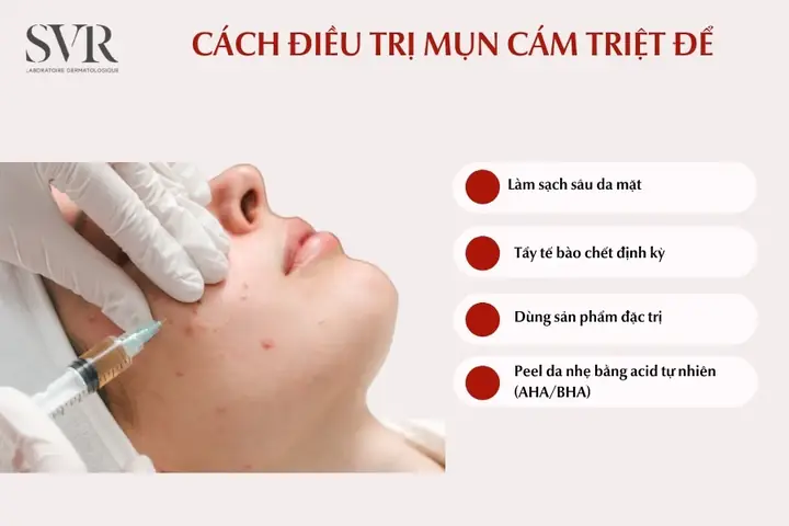 Cách Điều Trị Mụn Cám Triệt Để
