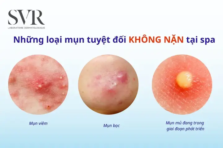 Loại Mụn Nào Không Nên Nặn Ở Spa?