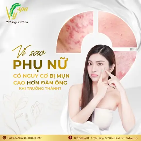 Vì Sao Nên Chọn Điều Trị Mụn Tại Vy Spa?