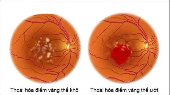 Giảm Nguy Cơ Thoái Hóa Điểm Vàng Giảm Nguy Cơ Thoái Hóa Điểm Vàng