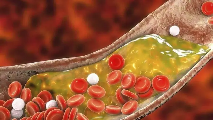 Giảm Mức Cholesterol Máu Giảm Mức Cholesterol Máu