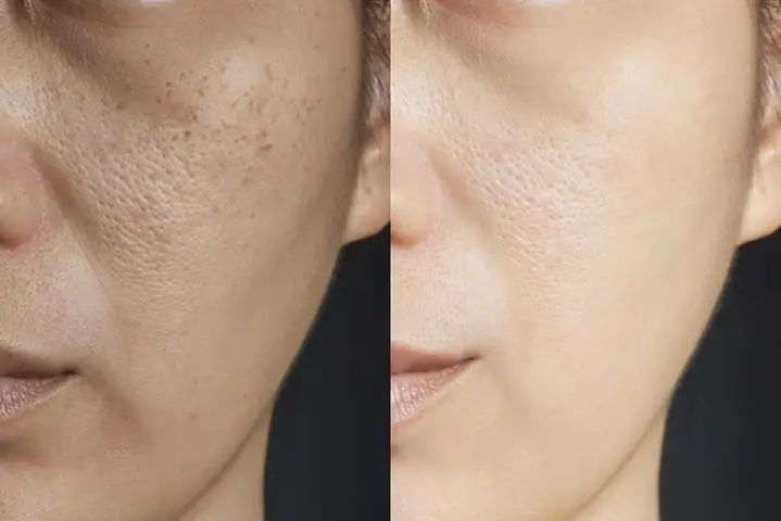 Cách Chăm Sóc Da Sau Peel Để Tránh Biến Chứng