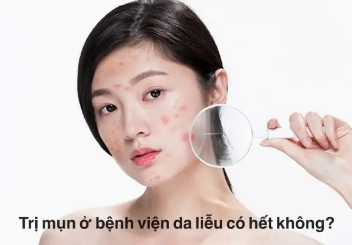 Trị Mụn Ở Bệnh Viện Da Liễu Có Hết Không Trị Mụn Ở Bệnh Viện Da Liễu Có Hết Không